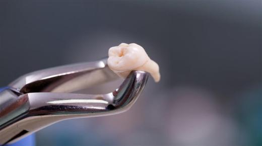 კბილის ამოღება სიზმარში იბნ სირინის მიერ და სიზმრის ინტერპრეტაცია კბილის ხელით ამოღების შესახებ