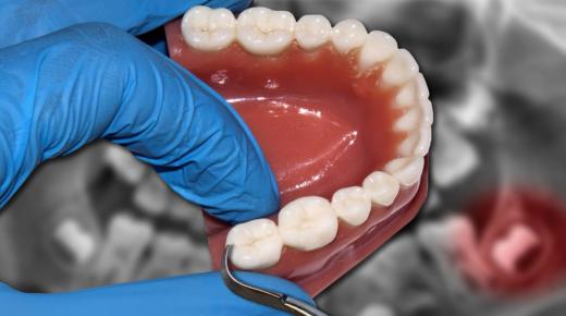 Sve što tražite da znate tumačenje snova o vađenju zuba kod doktora