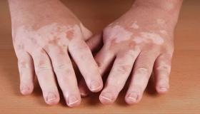 Waxa aanad ka garanayn tafsiirkii vitiligo riyada ee uu ibnu Siriin ku arkay