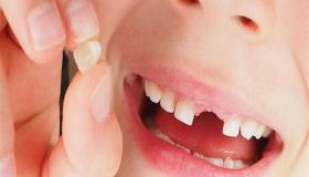 تفسير رؤية وقوع الأسنان في المنام لابن سيرين والنابلسي