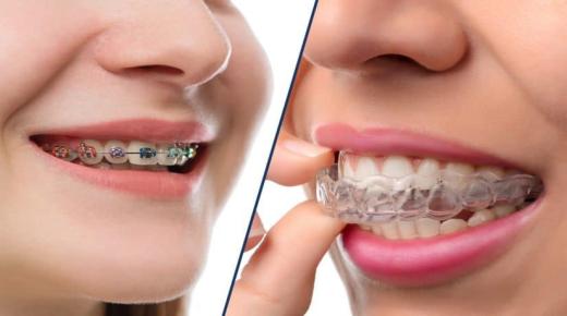 ما هو تفسير رؤية تقويم الأسنان في المنام لابن سيرين؟