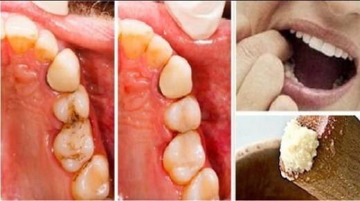 ما هي فوائد القرنفل للأسنان؟