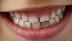 इब्न सिरिन द्वारा सपने में दांतों के टूटने के बारे में सपने की सबसे महत्वपूर्ण 20 व्याख्या