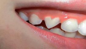 ما هو تفسير رؤية سقوط الأسنان في المنام للعزباء لابن سيرين؟