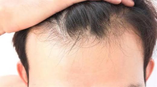 इब्न सिरिन के अनुसार पुरुषों के लिए बालों के झड़ने के सपने की व्याख्या क्या है?